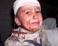 An Injured Iraqi child - Photo by March for Justice