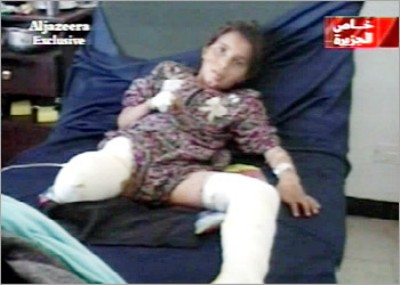 An injured girl, her leg amputated - Al Jazeera